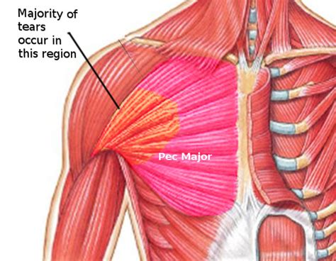 Figure Pectoralis Major Tears Image Courtesy S Bhimji Md