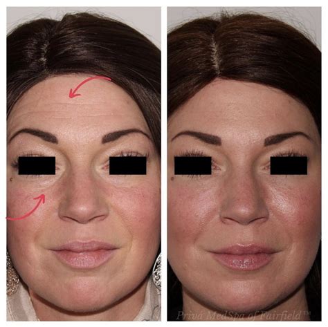 Patient 24987368 Tear Trough Fillers Before And After Photos