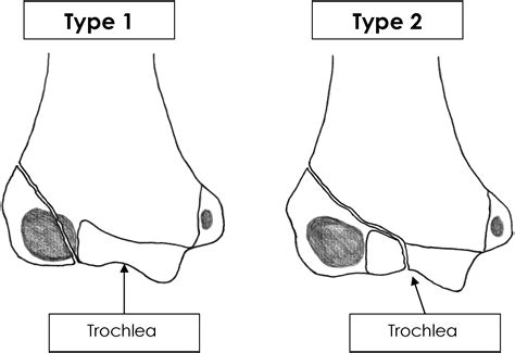 Milchs Classification Of Paediatric Lateral Condylar Mass Fractures Analysis Of Inter And