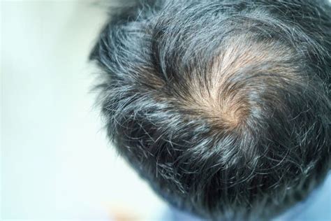 Hair Transplant In Mexico Cancun Hair Restoration