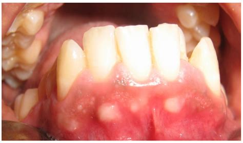 Ibima Publishing Gingival Fibrous Nodules Report Of Four Cases