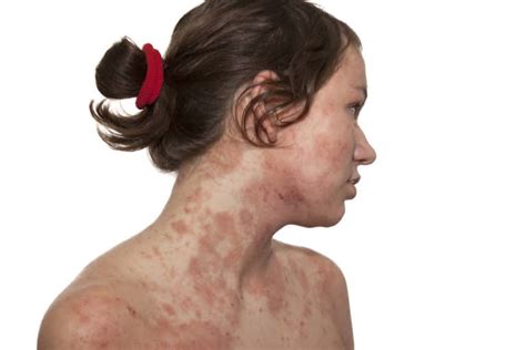 Different Types Of Dermatitis Eczema