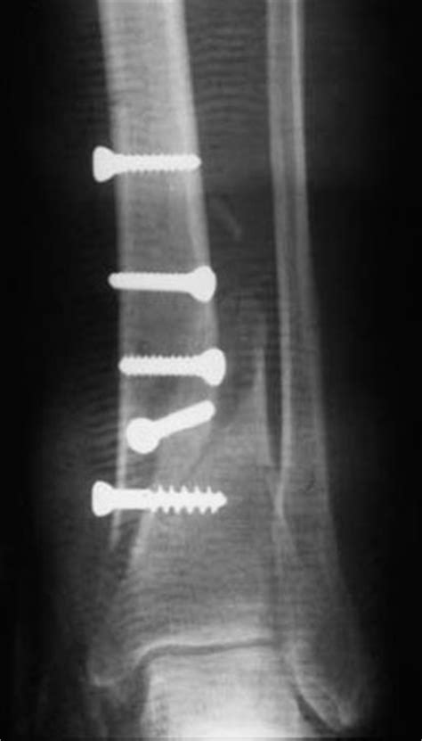 Surgical Treatment Of Osteomyelitis Musculoskeletal Key