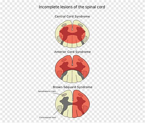 Anterior Spinal Artery Syndrome