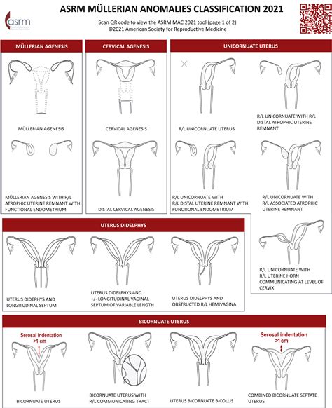 Asrm Müllerian Anomalies Classification 2021 Fertility And Sterility