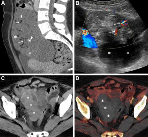 Adnexal Lesion Imaging Past Present And Future Radiology