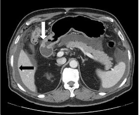 Contrast Enhanced Abdomen Ct Nodularity Of Inner Layer With Mucosal Download Scientific