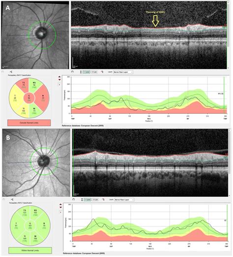 Measurement Of The Retina Nerve Fiber Layer Rnfl Thickness A Rnfl