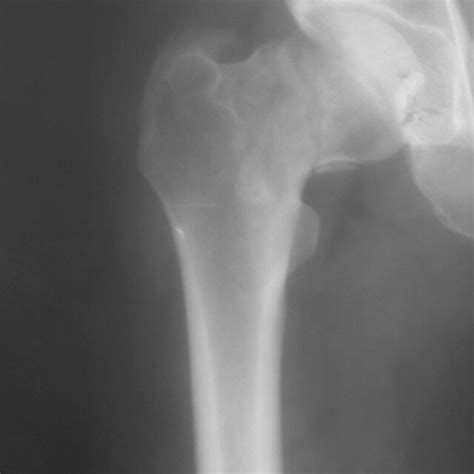 A Preoperative A P Radiograph Of Hip Joint Of Years Old Man With A