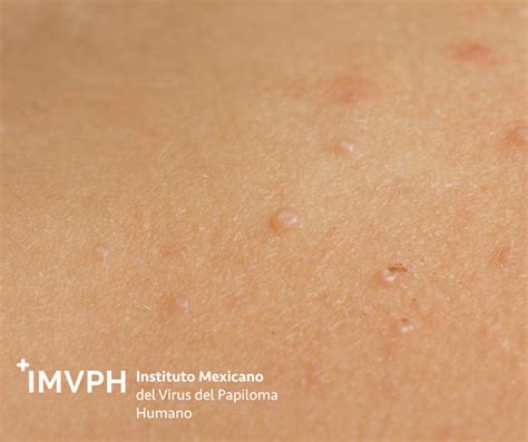 Molusco Contagioso En Las Manos