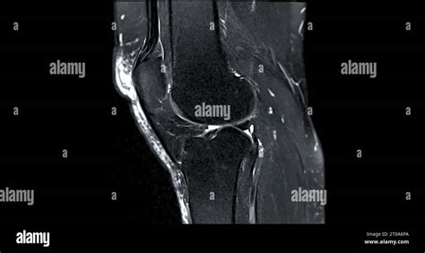 Magnetic Resonance Imaging Or Mri Of Knee Joint C For Detect Tear Or