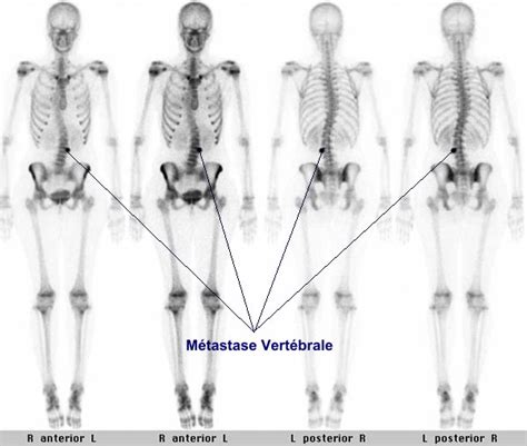 Scintigraphie Osseuse Metastase Vertebrale