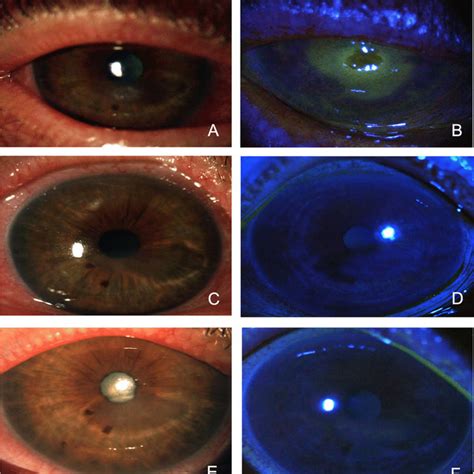 The Cenegermin Eye Drops Group Had Significantly Longer Recurrence Free Download Scientific