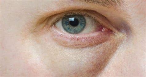 7 Causes Of Puffy Swollen Eyes