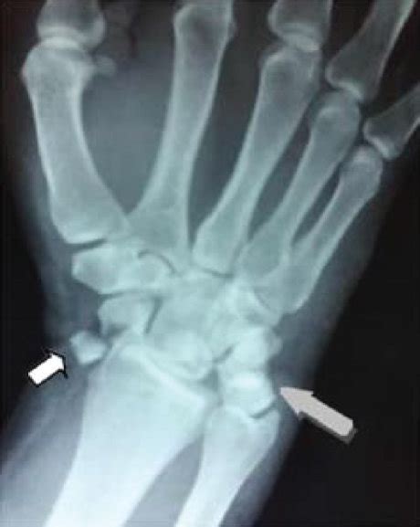 Preoperative X Rays Of The Left Wrist Grey Arrow Shows The Lunate Download Scientific Diagram