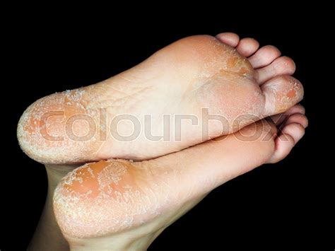 Skin peeling off from both feet on ... | Stock image | Colourbox