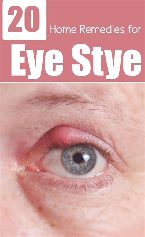 Best Way To Treat A Stye Under The Eyelid At Marvin Haddad Blog