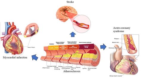 Atherosclerosis and the related CVDs. Atherosclerosis development and ...