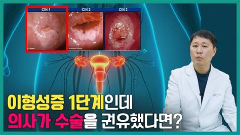 자궁경부 원추절제술 이형성증 1단계 수술을 권유받았다면 Youtube