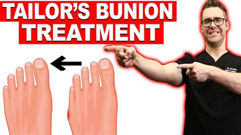 Tailor S Bunion Bunionette Treatment Correctors Surgery Youtube