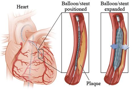 Primary Angioplasty