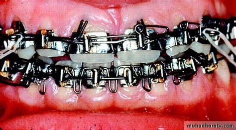 Fixed Orthodontic Appliances Pptx Drhakam Muhadharaty