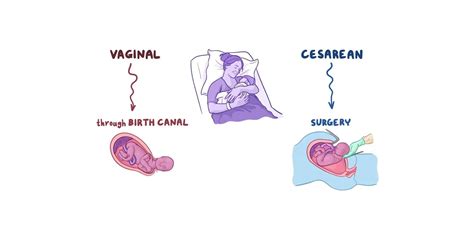 Advantages And Disadvantages Cesarean Delivery Vs Normal Delivery