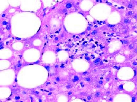 Liver histology showing macrovesicular steatosis in a subject with ...