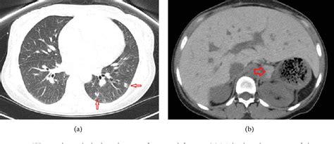 Figure 1 from Mycobacterium avium Complex Infection in a Patient with ...