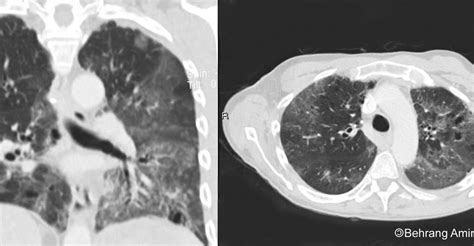 Simple Pulmonary Eosinophilia Pictures