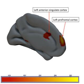 Statistical Parametric Map Of Longitudinal Changes In Mean Cerebral