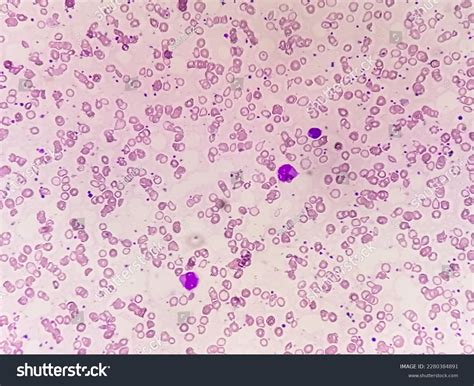 Blood Filmrbc Hypochromic Anisocytosis Microcytes Target Stock Photo 2280384891 | Shutterstock