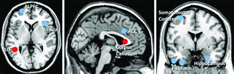 Diferencias En La Estructura Cerebral De Practicantes De Meditaci N