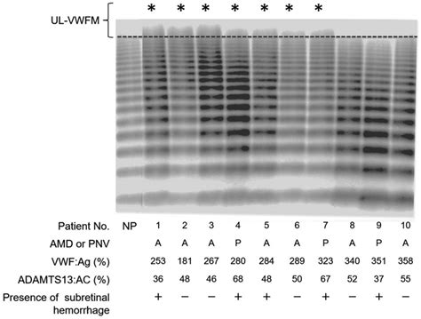 Von Willebrand Factor Vwf Multimer Analysis In Representative Cases