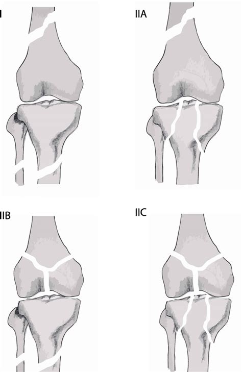 Floating Knee Definition Causes Symptoms Diagnosis Treatment