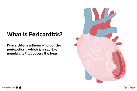 Pericarditis Causes