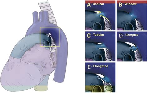 Clinical Outcomes After Percutaneous Patent Ductus Arteriosus Closure