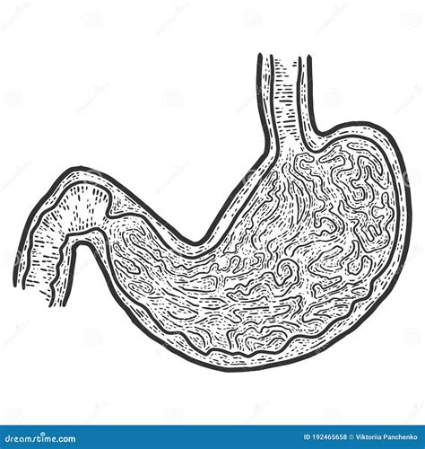 Section 3d Of The Stomach Peptic Ulcer Disease Gastric Ulcer Is A