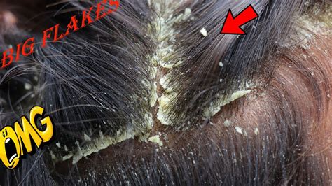 Itchy Psoriasis Scalp Dandruff Flakes Scratching Scratching Huge Flakes Youtube