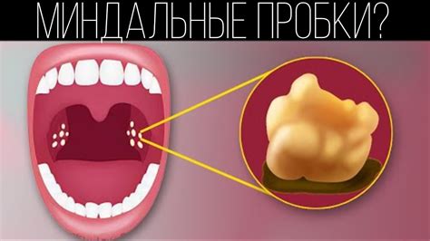 Как лечить миндальные пробки? | ПОЛЕЗНЫЙ ЮТУБ - YouTube