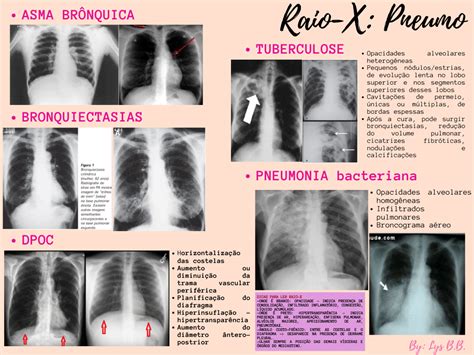 Raio X Pneumo 1 Asma brônquica Raio x Material de enfermagem