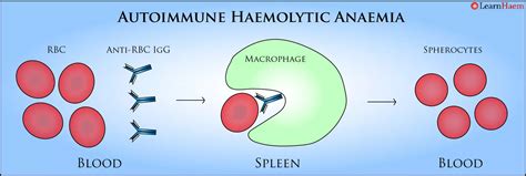 Autoimmune Haemolytic Anaemia Learnhaem Haematology Made Simple