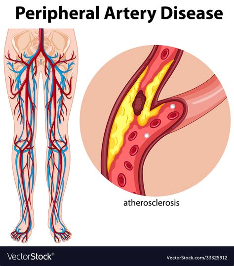 Medical Peripheral Artery Disease Royalty Free Vector Image