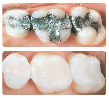 Esthetic Tooth Fillings | The Dental Arcade – Blog