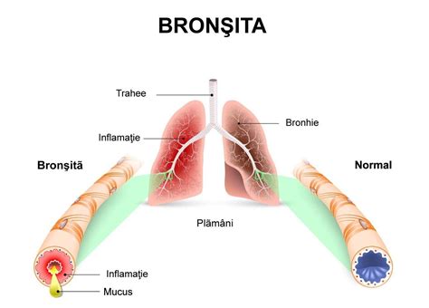 Bron Ita Cauze Simptome Diagnostic Si Tratament Policlinica Hot Sex