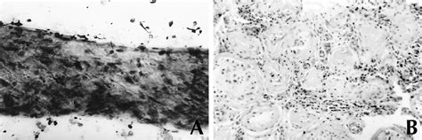 Figure From Testicular Fine Needle Aspiration Cytology For The