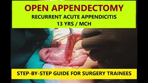 How To Do Safe Open Appendectomy Complete Guide For Beginners Video