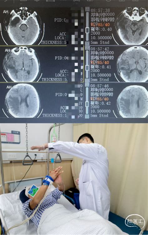 监测有道丨急性大面积脑梗死早期去骨瓣减压1例——颅脑创伤 神经重症周刊（第331期） 脑医汇 神外资讯 神介资讯