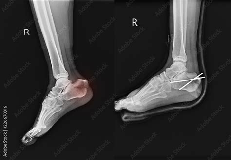 X-ray Fracture calcaneus-heel and Post operation fixcation. Stock Photo | Adobe Stock