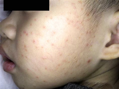 Viral Rash On Face